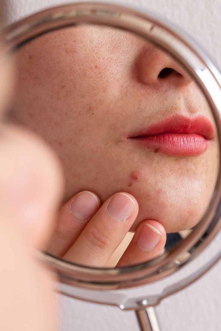 Acne care