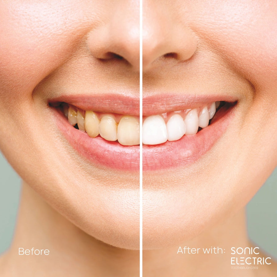 [1 free 2] Dentiste Sonic Electronic Toothbrush 5 Mode  free Extra Fresh Spray 3 ml & Plaque Test 10s.