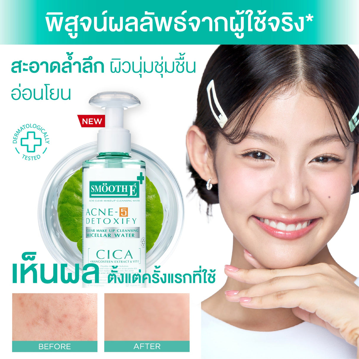 Smooth E Acne-5 Clear Makeup Cleansing Water